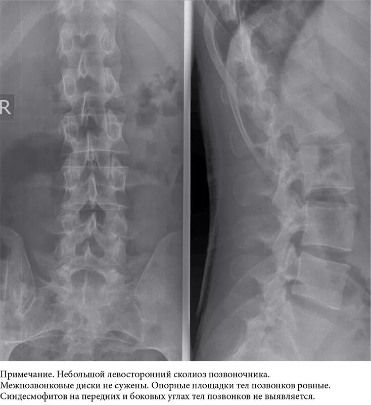 Рентген поясничного отдела фото Поздняя диагностика анкилозирующего спондилита с ювенильным началом (клиническое