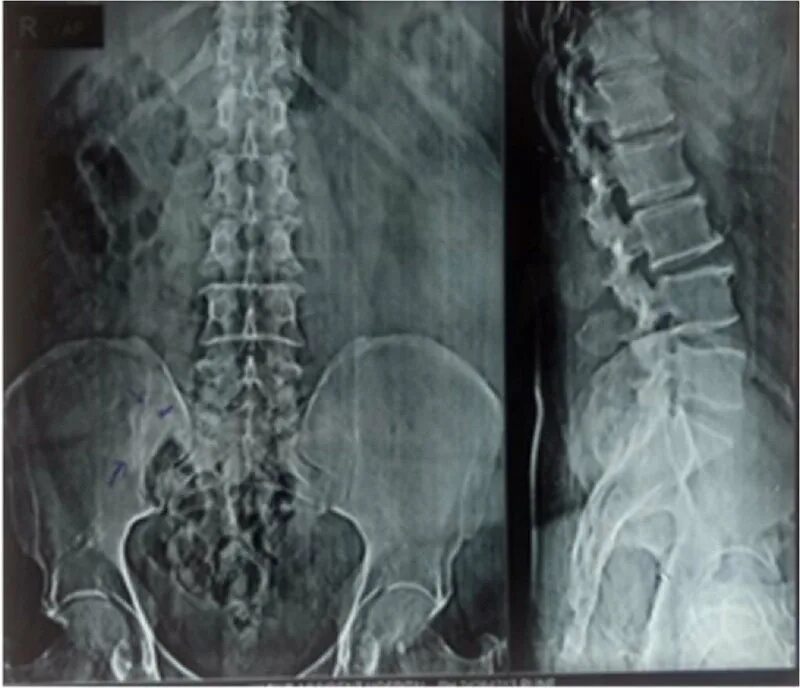 Рентген поясничного отдела фото Pre-operative radiograph of lumbosacral spine anteroposterior and... Download Sc