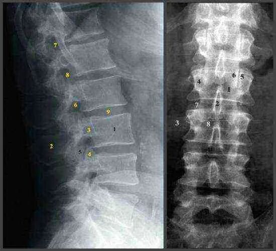 Рентген поясничного отдела как делают фото Рентген поясничного отдела как делают