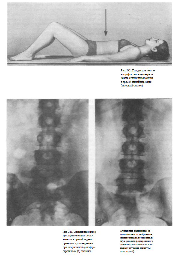 Рентген поясничного отдела как делают женщинам фото Атлас укладок при рентгенологических исследованиях (Кишковский А.Н.) - Глава 4. 