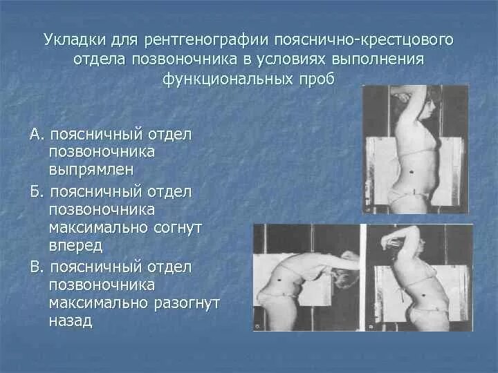 Рентген поясничного отдела как делают женщинам фото Функциональная рентгенография позвоночника