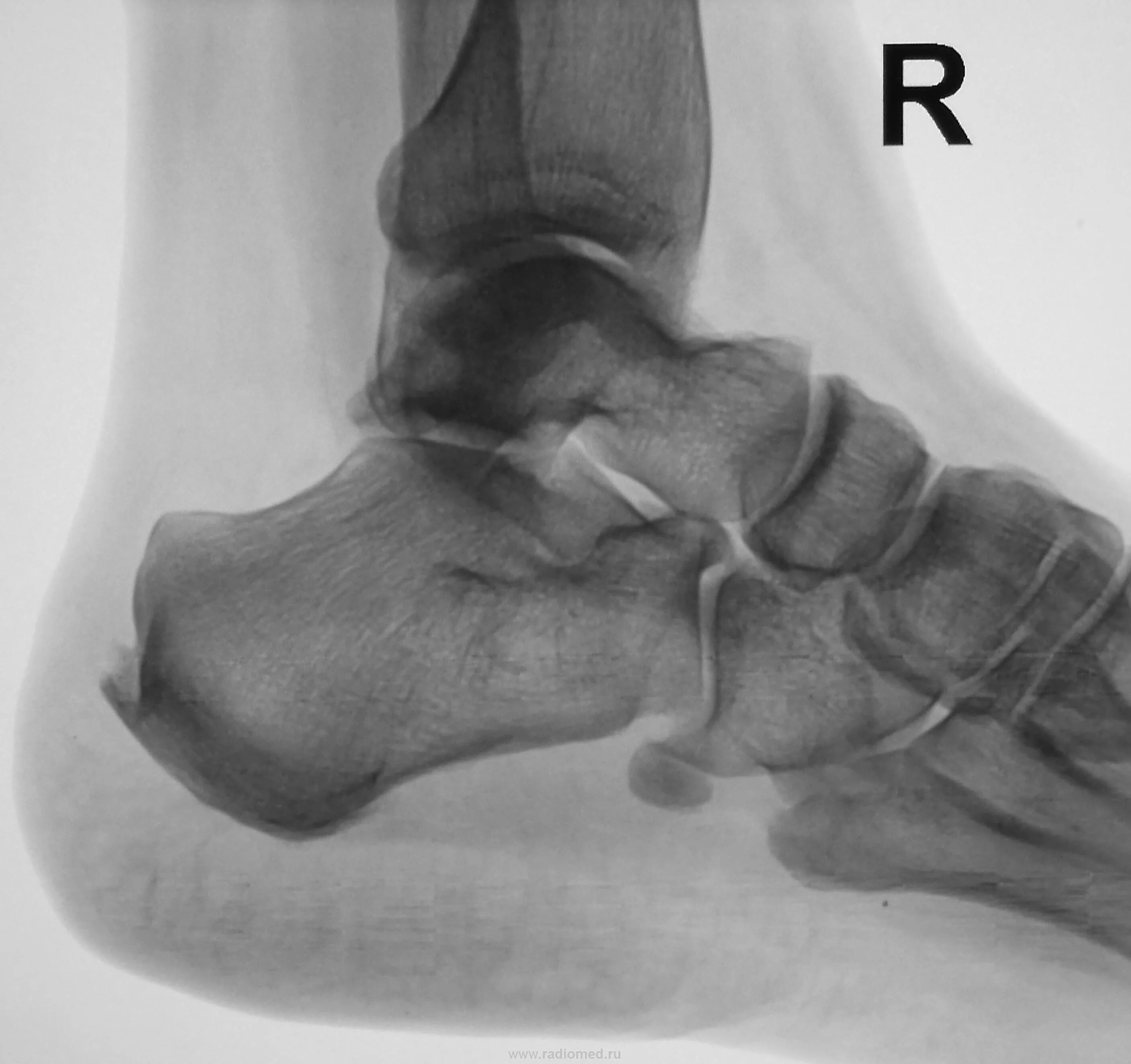 Рентген пяточной кости норма фото Пациент направлен на рентгенографию пяточной кости Портал радиологов