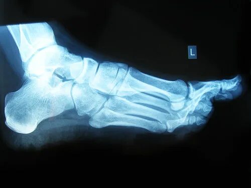 Рентген пяточной кости норма фото No fracture. Doc said I had a case of "Radioactive Therapy. Flickr