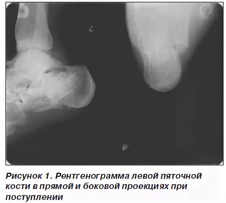 Рентген пяточной кости норма фото Наш опыт оперативного лечения внутрисуставных компрессионных переломов пяточной 