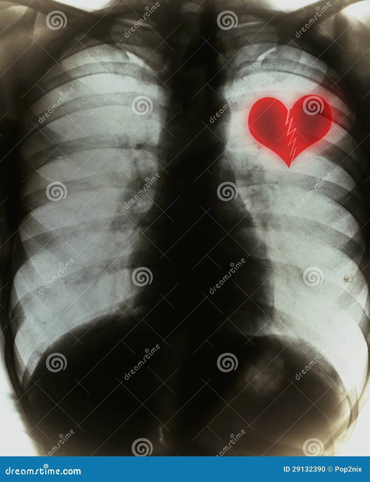 Рентген сердца фото Broken heart stock illustration. Illustration of disease - 29132390