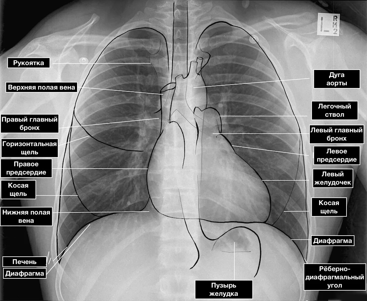 Рентген сердца фото Рентгенограмма органов грудной полости - норма - 24Radiology.ru