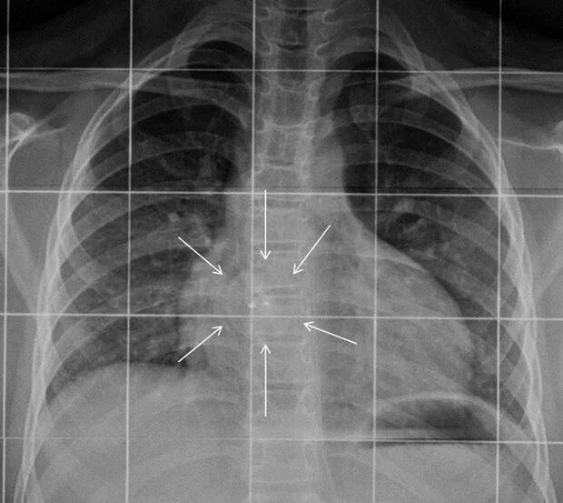 Рентген сердца фото China Heart Defect Closure Devices Industry Key Manufacturers Analysis 2017-2022