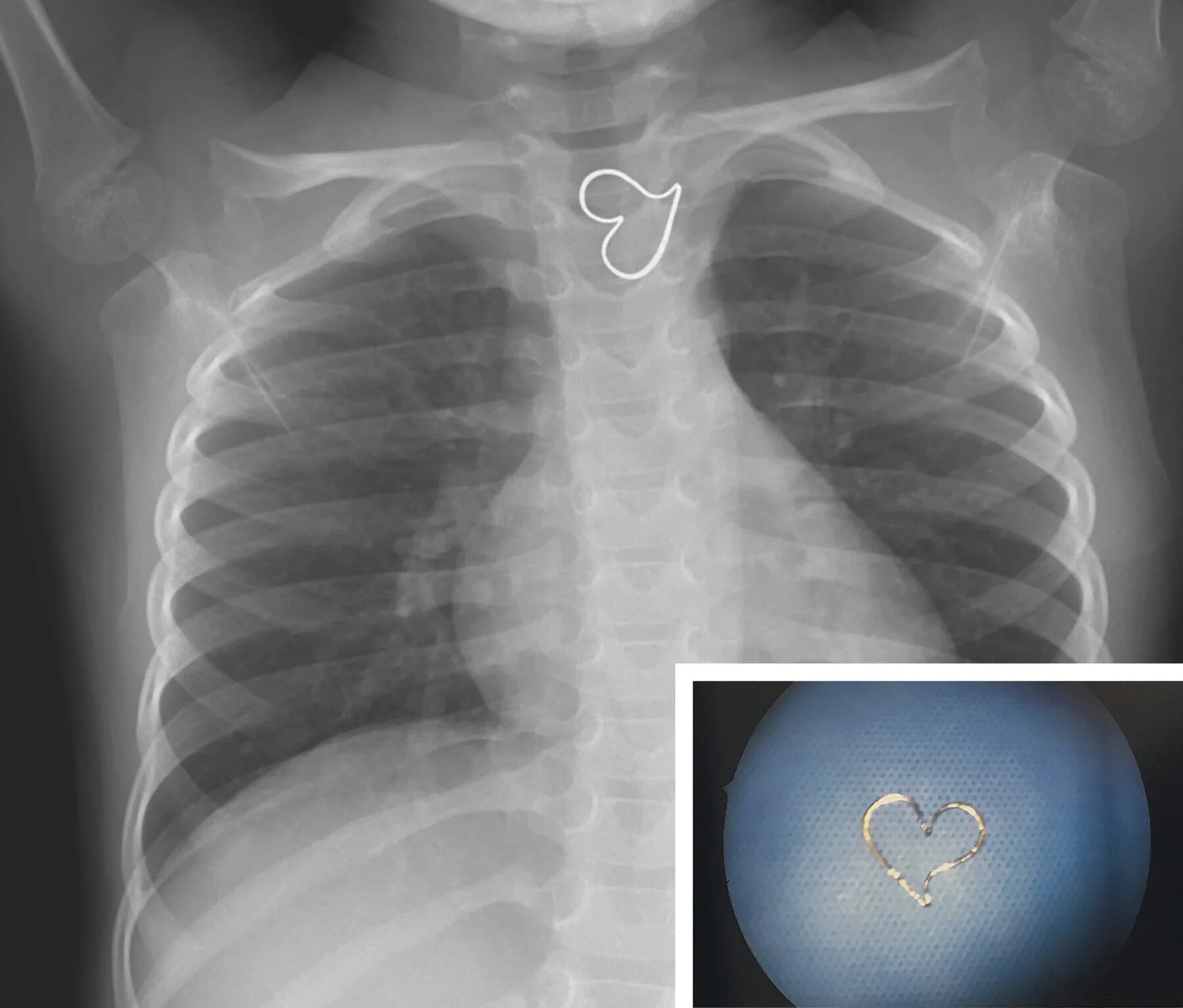 Рентген сердца фото Heart-shaped pendant lodged in 3-year-old’s throat