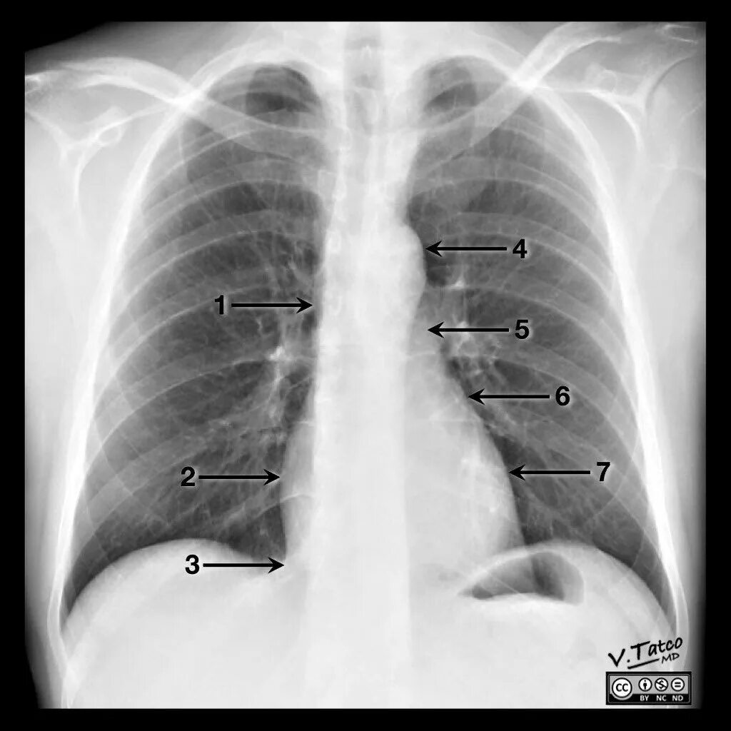 Рентген сердца фото Pin en Radiologia