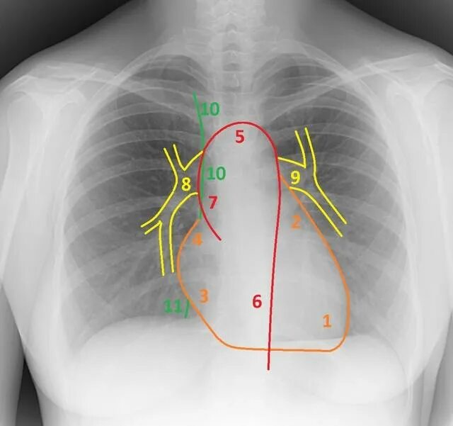 Рентген сердца фото Что значит расширенное сердце на рентгене: найдено 90 изображений