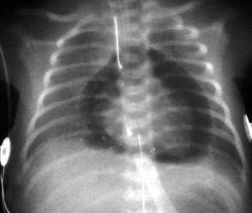 Рентген сердца фото Cardiac tamponade on x-ray So cool ( ya know if its not you) (With images) Icu n