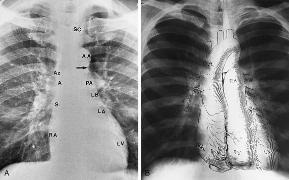 Рентген сердца фото The Chest Radiograph in Cardiovascular Disease Thoracic Key