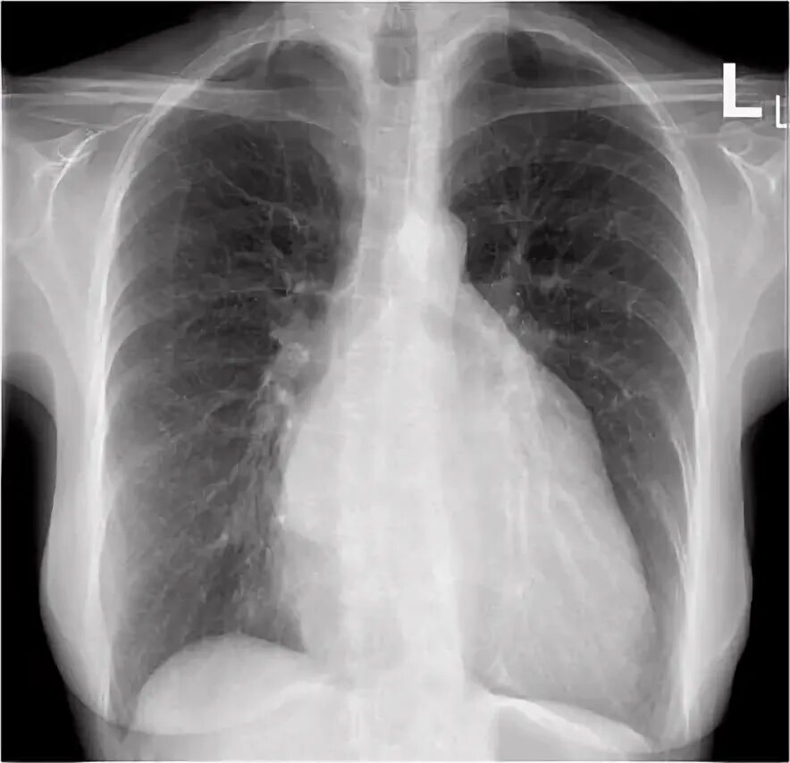 Рентген сердца фото Mitral valve regurgitation Radiology Case Radiopaedia.org