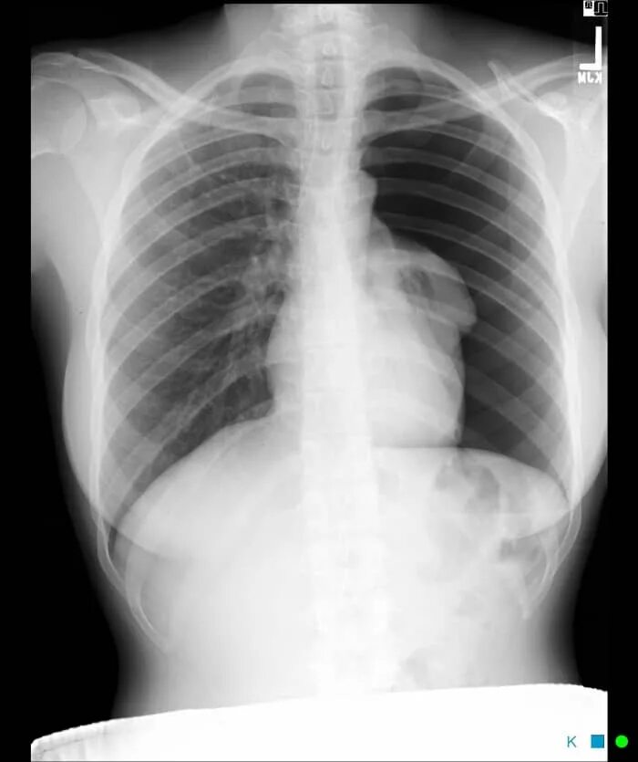 Рентген сердца фото Reading The Chest X-Ray (Chest Radiography): Identifying A Normal Chest X-Ray - 