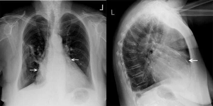 Рентген сердца фото Image: Chest X-Ray of a Patient with Constrictive Pericarditis - MSD Manual Prof