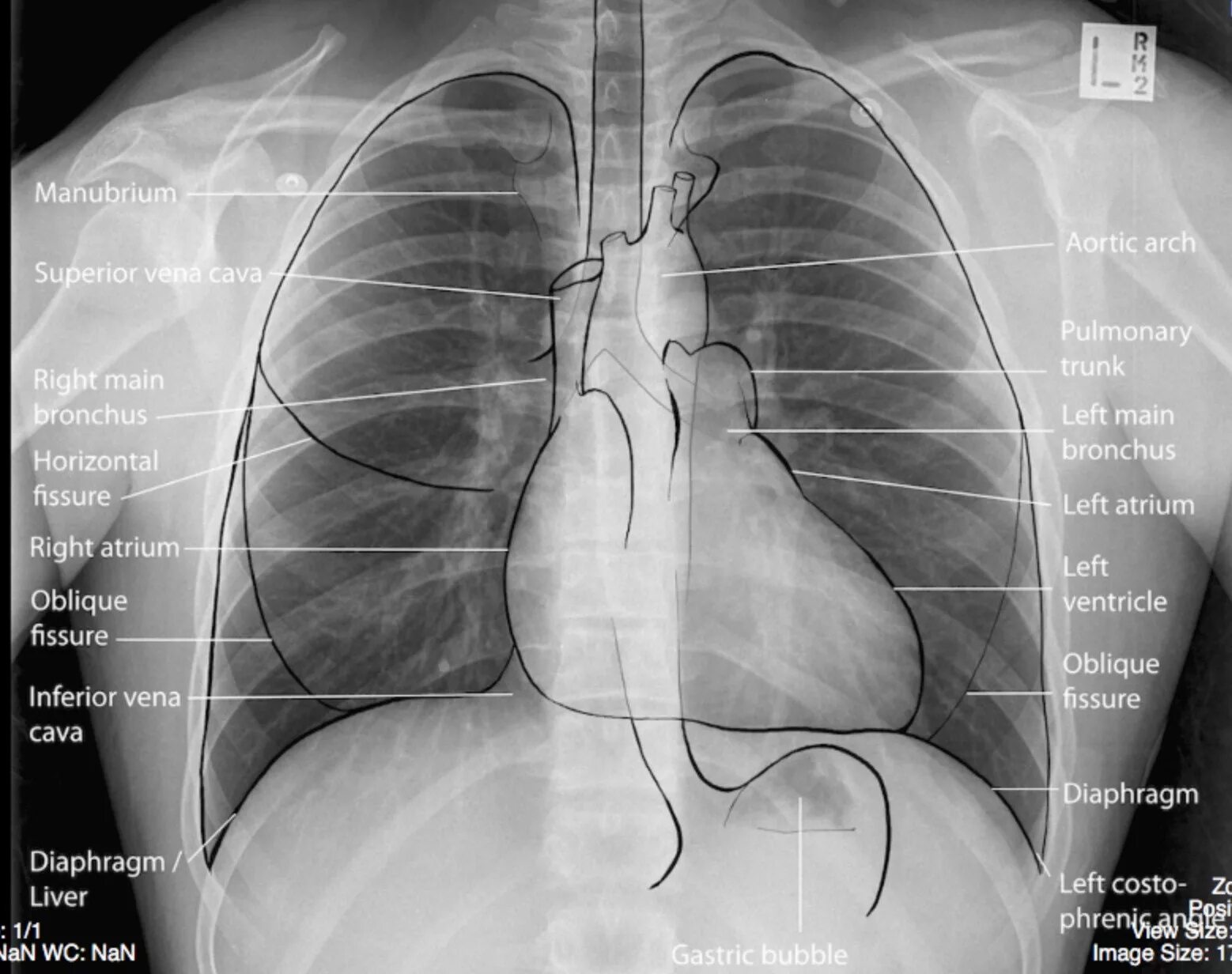 Рентген сердца фото Normal, Labelled, Chest x-ray, with Cardiovascular Structures - Undergraduate Di