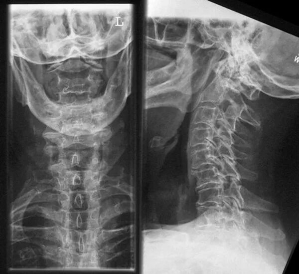 Рентген шейного отдела фото Odontoid process metastasis of bronchial carcinoma as a rare cause for nonmechan