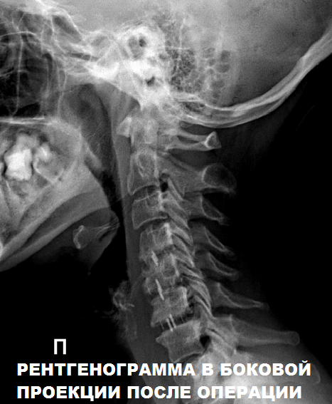 Рентген шейного отдела фото НАШИ БУДНИ: Современные технологии позволяют проводить вмешательства на позвоноч