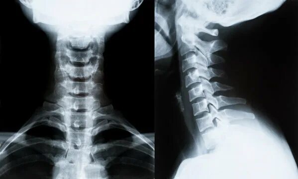 Рентген шейного отдела фото Neck Xray Изображения: просматривайте стоковые фотографии, векторные изображения