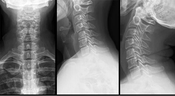 Рентген шейного отдела позвоночника фото Профессиональный подбор ортопедических подушек и матрасов. - "Доктор Гален" конс