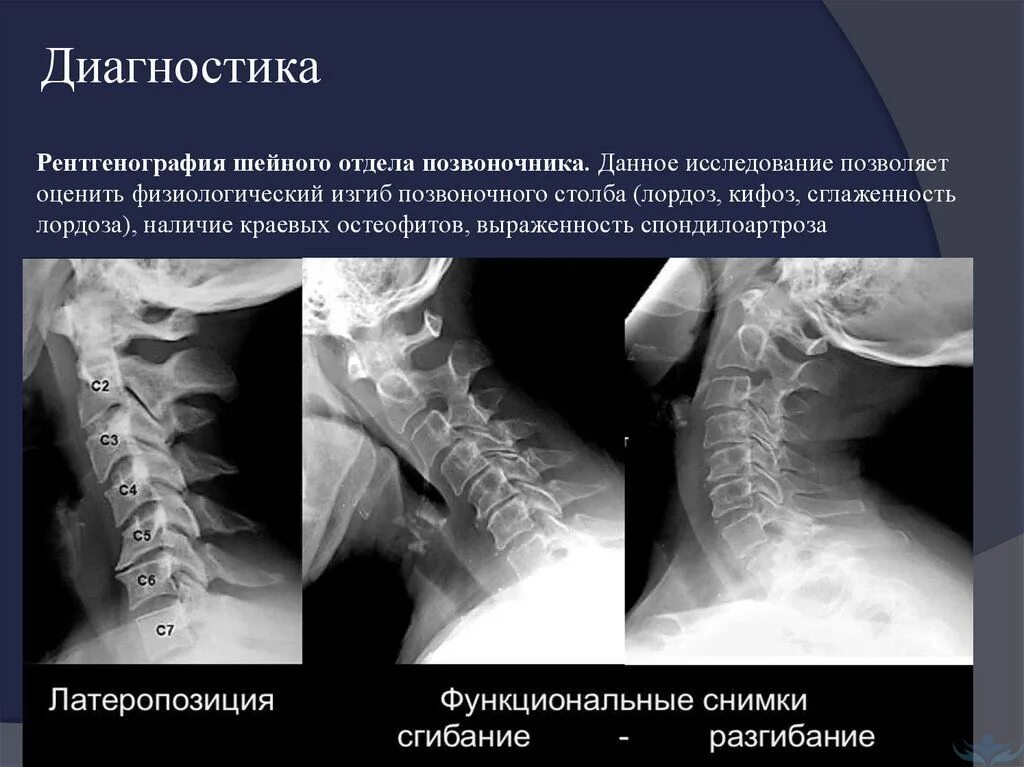 Рентген шейного отдела позвоночника фото Головная боль в затылке: основные причины и методы лечения у женщин и мужчин