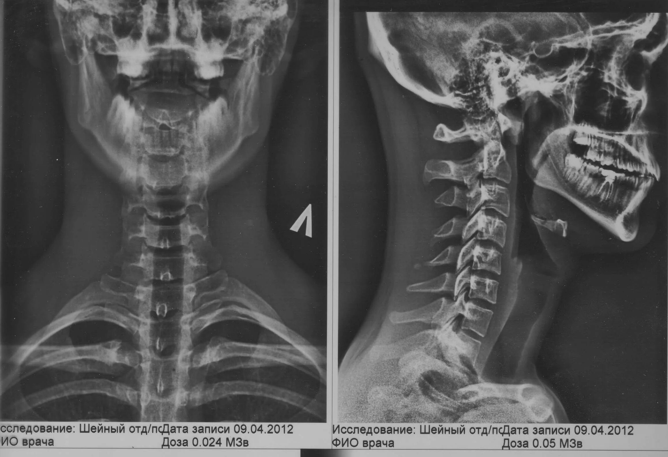 Рентген шейного отдела здорового человека фото Исследование шейного отдела позвоночника Портал радиологов