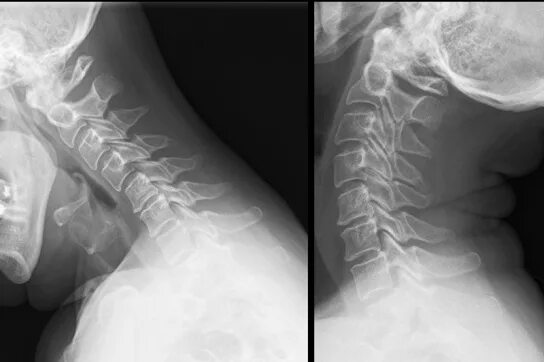 Рентген шейного отдела здорового человека фото Рентген шейного отдела позвоночника: что показывает