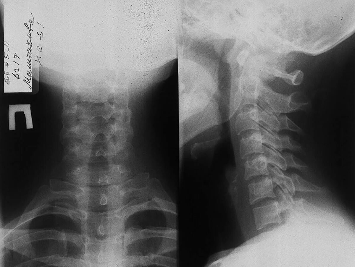 Рентген шейного отдела здорового человека фото Сделать рентген шейного отдела позвоночника