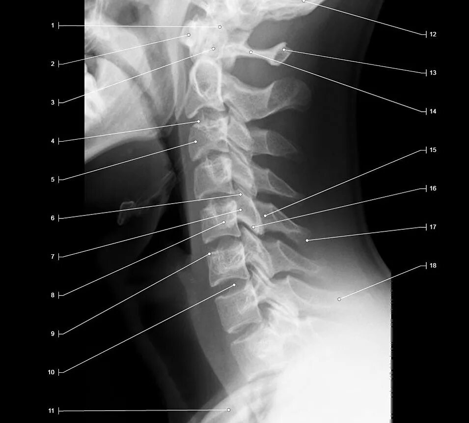 Рентген шейного отдела здорового человека фото Рентген позвоночника нижний новгород - найдено 90 картинок