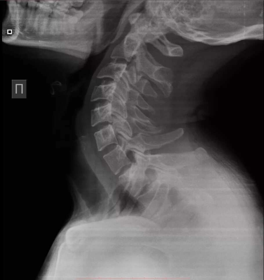 Рентген шейного отдела здорового человека фото Ребенок рентген шейного