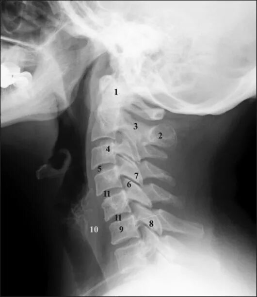Рентген шейного отдела здорового человека фото ГЛАВА 2. ПОЗВОНОЧНИК