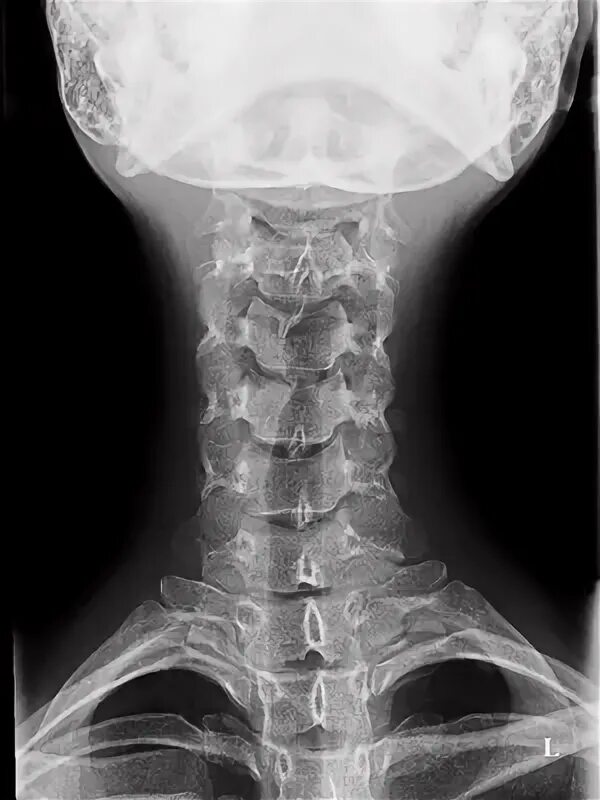 Рентген шейного отдела здорового человека фото Рентген шейного отдела позвоночника в Москве - сделать рентгенографию шейного от