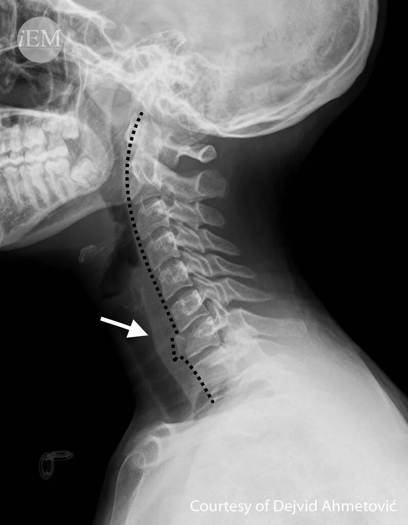 Рентген шейного отдела здорового человека фото 626.5 - Figure 5 - fracture of the body of C7. Figure 5: D. Flickr