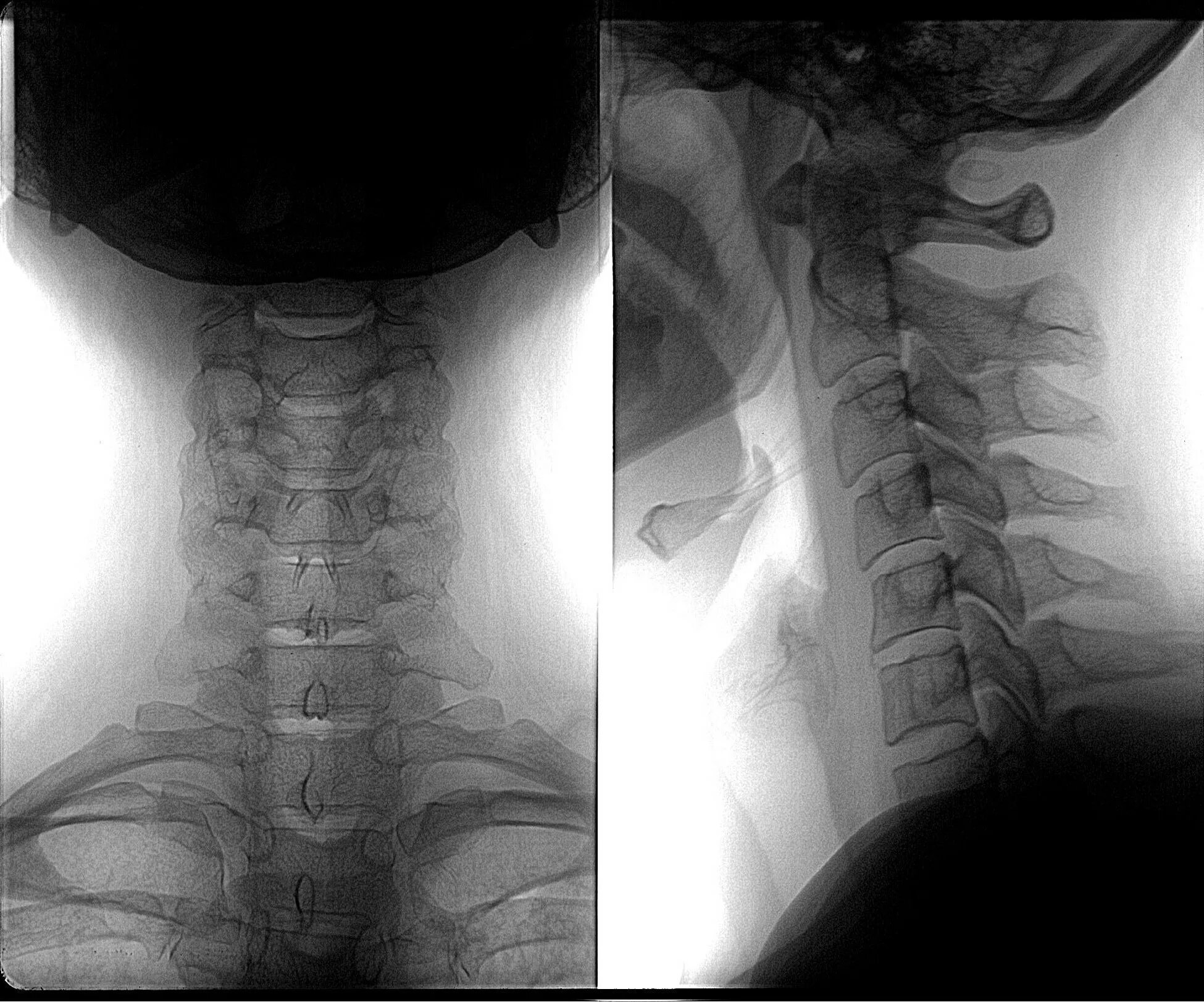 Рентген шейного отдела здорового человека фото Рентген шейного отдела позвоночника - Olphoto.ru