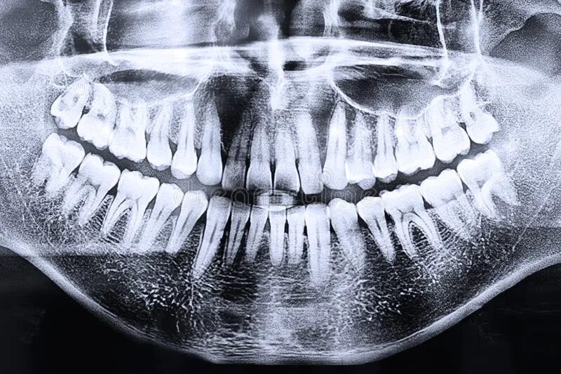 Рентген зубов фото Anatomy Of A Dental Model Concept Of A Dentist Cross Section For Education. The 