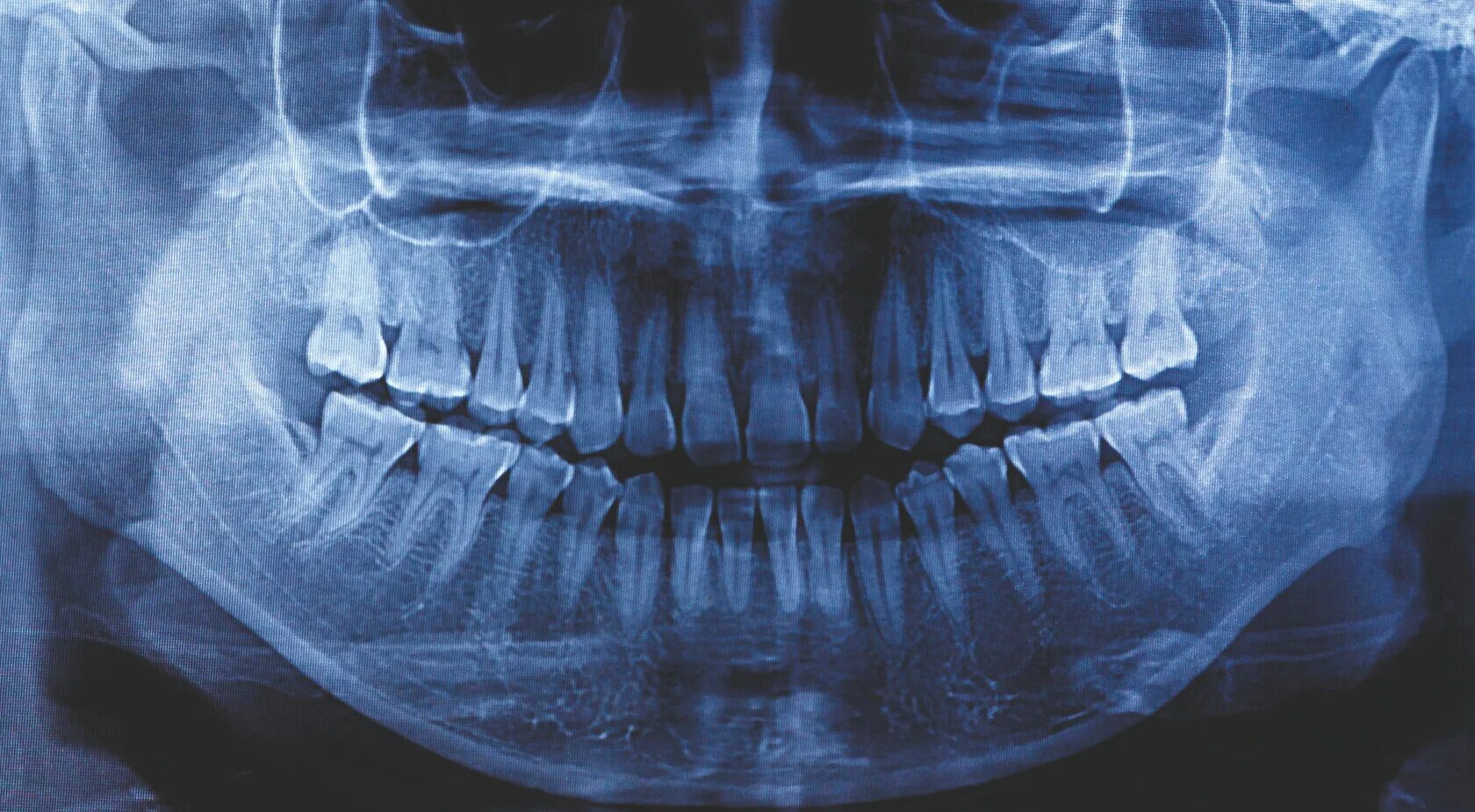 Рентген зубов фото ОПТГ зубных рядов
