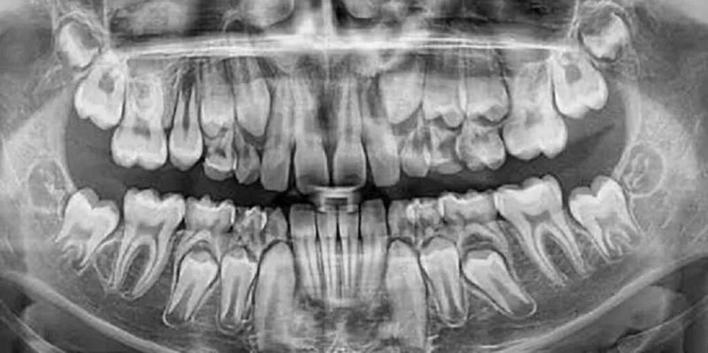 Рентген зубов фото Бутерброд и ротовая полость