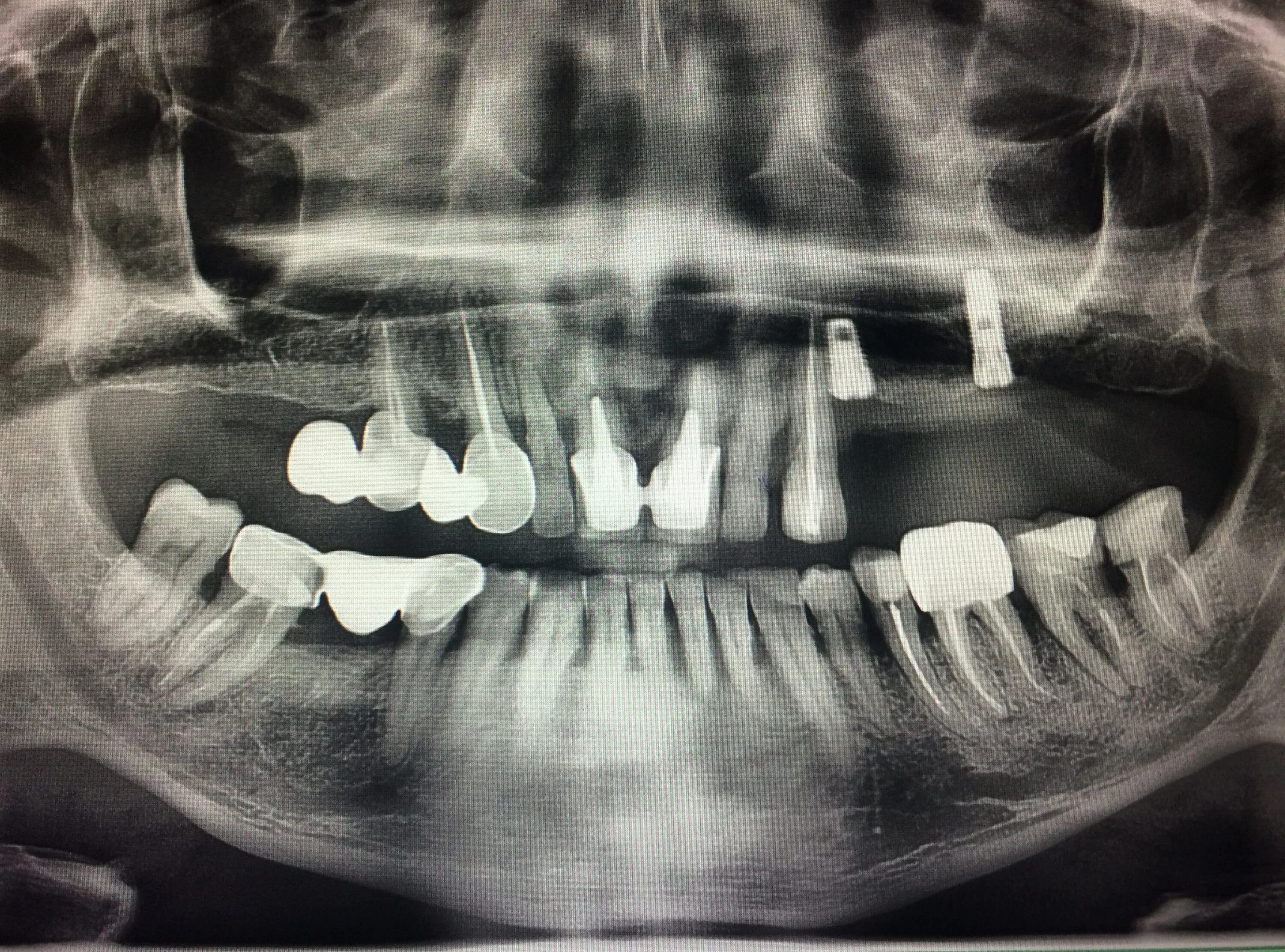 Рентген зубов фото имплантация зубов ООО "Фабрика улыбок"