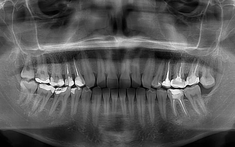 Рентген зубов фото 3D диагностика зубов в стоматологии в Саратове ПрезидиумМед