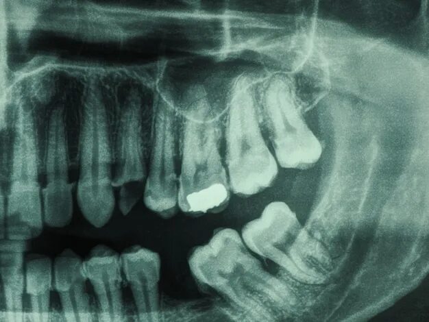 Рентген зубов фото как выглядит 79,000+ Xray Tooth Pictures