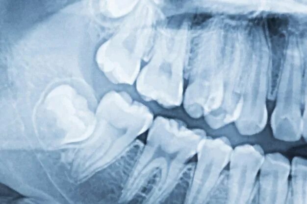 Рентген зубов фото как выглядит Radiografía dental panorámica de una boca izquierda y derecha. Foto Premium Free