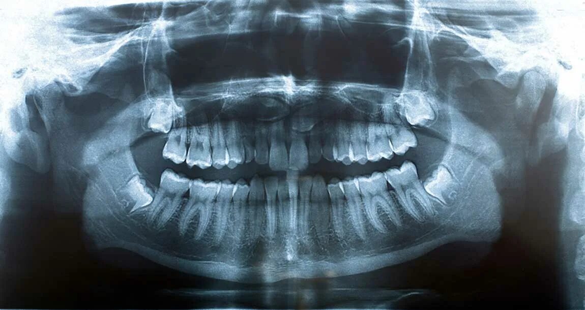 Рентген зубов фото как выглядит Чем отличается панорамный снимок зубов от 3D преимущества, недостатки