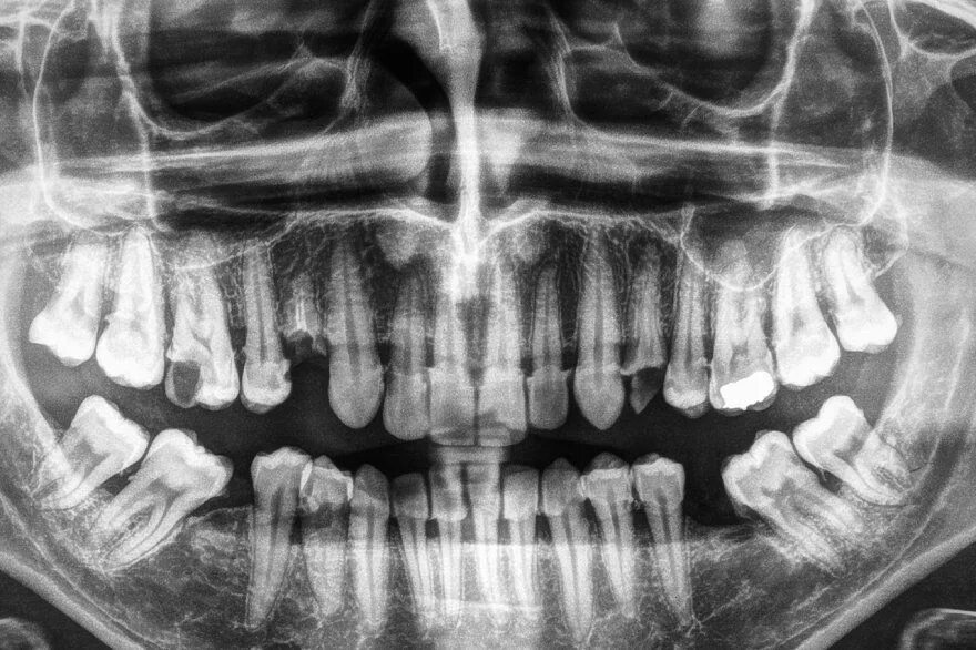 Рентген зубов фото как выглядит Human teeth xray in black and white