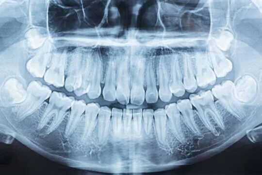 Рентген зубов фото как выглядит Teeth Xray Зображення - огляд 27,500 Стокові фото, векторні зображення й відео A