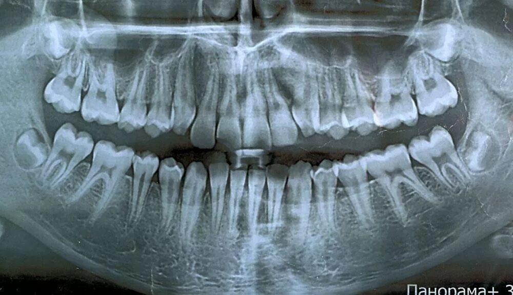 Рентген зубов фото как выглядит Рентген зуба. Сделать рентгеновский снимок зубов в Москве НоваДент