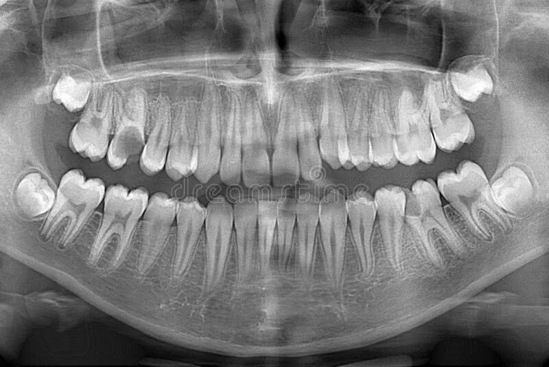 Рентген зубов фото как выглядит 453 череп рентгена фото стоковые фото - бесплатные и стоковые фото RF от Dreamst
