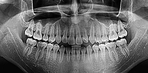 Рентген зубов фото как выглядит Информация для ортодонтических пациентов - Ортодонтия - АО "Стоматологическая по
