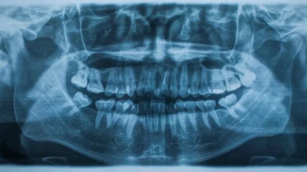 Рентген зубов фото как выглядит Page 4 87,000+ Dental Xray Pictures