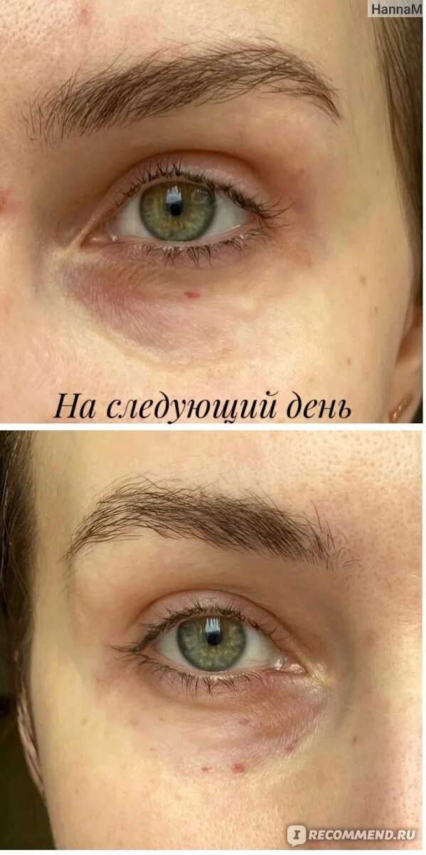 Реви ай под глаза фото Биоревитализация препаратом Revi Eye Correction - "Биоревитализация кожи вокруг 