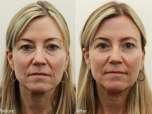 Реви фото до и после Dr. Darm, Eyelids Before and After - T.C. Eye surgery, Rhinoplasty, Plastic surg